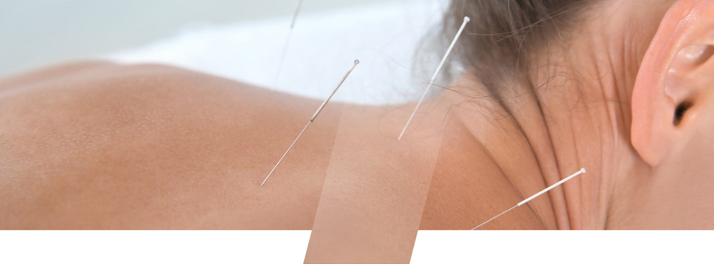 Acupuncture Acupuncture With Cal